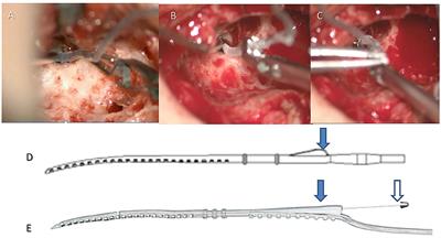 Robot-Assisted Electrode Array Insertion Becomes Available in Pediatric Cochlear Implant Recipients: First Report and an Intra-Individual Study